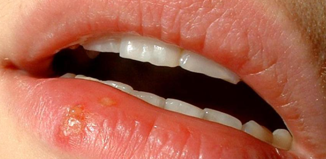 Herpes virusas